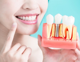 Chăm sóc răng sau cấy implant như thế nào ?
